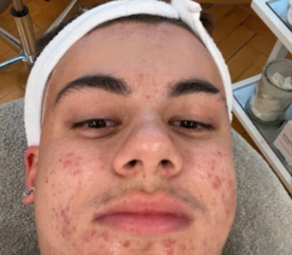 Max vor der Aknebehandlung bei Franziskaner Beauty in Luzern